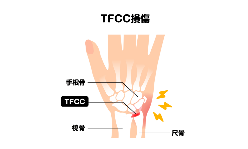 TFCC損傷