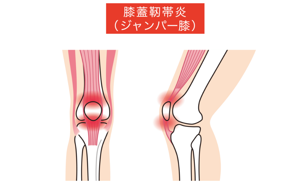 ジャンパー膝の解剖のイラスト